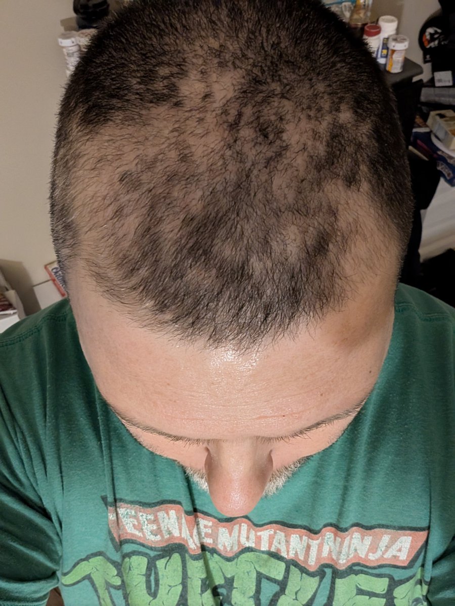 Gurds22's tweet photo. I had to buzz my hair because my hair was falling out 2 weeks after my first chemo treatment. This is now 3 weeks after and it's still falling out. My second treatment is tomorrow. At this rate I'll be bald like @KingRicochet in a few more weeks. https://t.co/aYRSCJGnnX