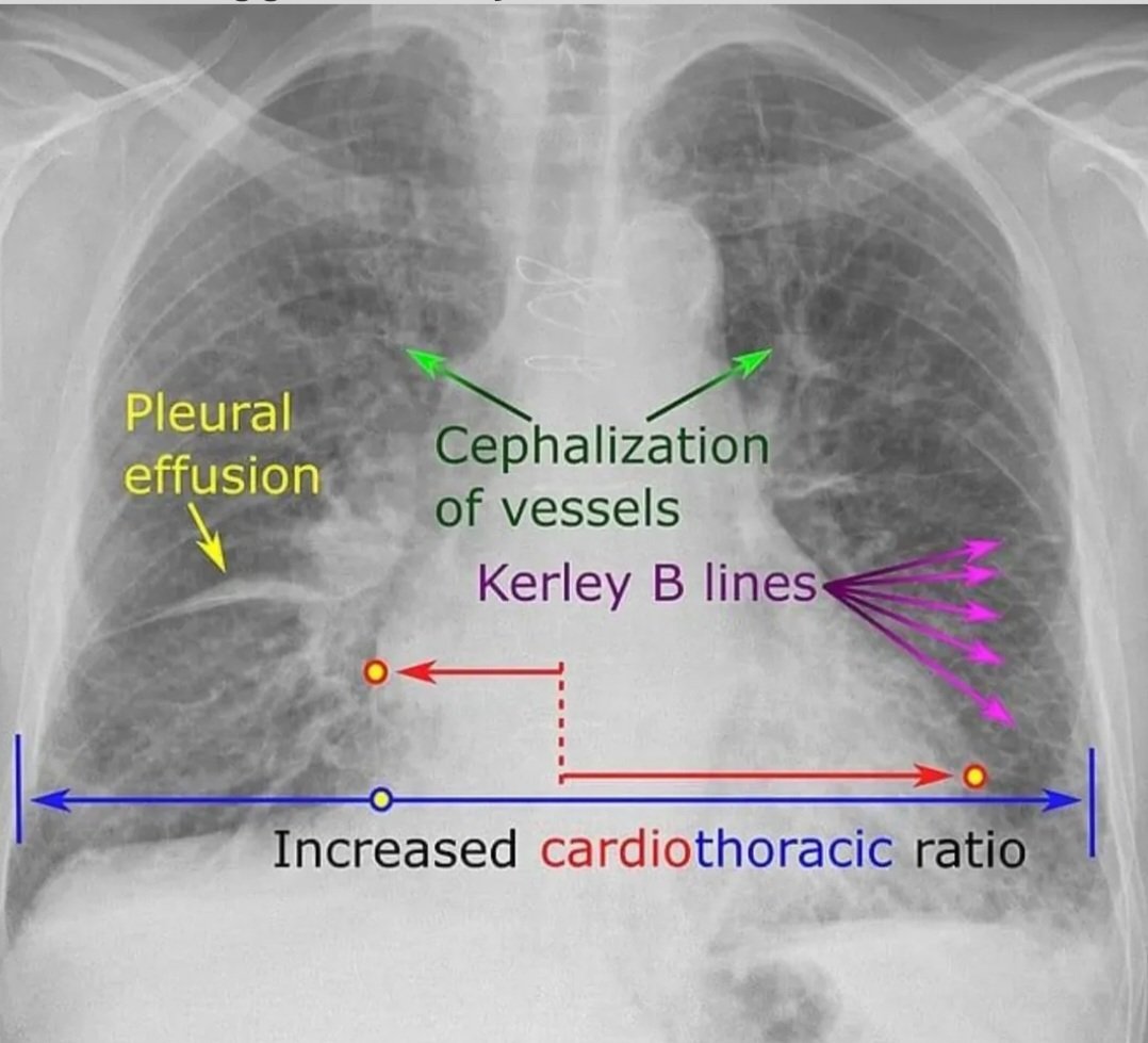 TrackYourHeart's tweet photo. Common radiographic signs of congestive heart failure include: 
◾Enlarged cardiac silhouette
◾left atrial enlargement
◾hilar fullness,
◾vascular redistribution
◾linear interstitial opacities   (Kerley’s lines)
◾bilateral alveolar infiltrates, ◾pleural effusions (right > left).