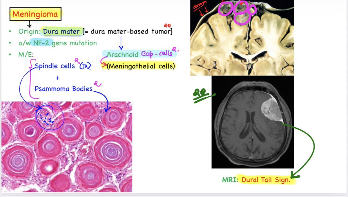 drdev555's tweet photo. 🕉 Meningioma:
➖➖➖➖➖➖➖➖➖➖➖➖
👉Lecture snapshot from “Integrated Concepts of Pathology” By Dr. Devesh Mishra 👍
👉Build Concepts.
👉Strengthen Clinical Thinking.
👉Succeed with Clarity.
#drdeveshmishra #dpma #neetpg #fmge #inicet https://t.co/qfUd6zpqOn