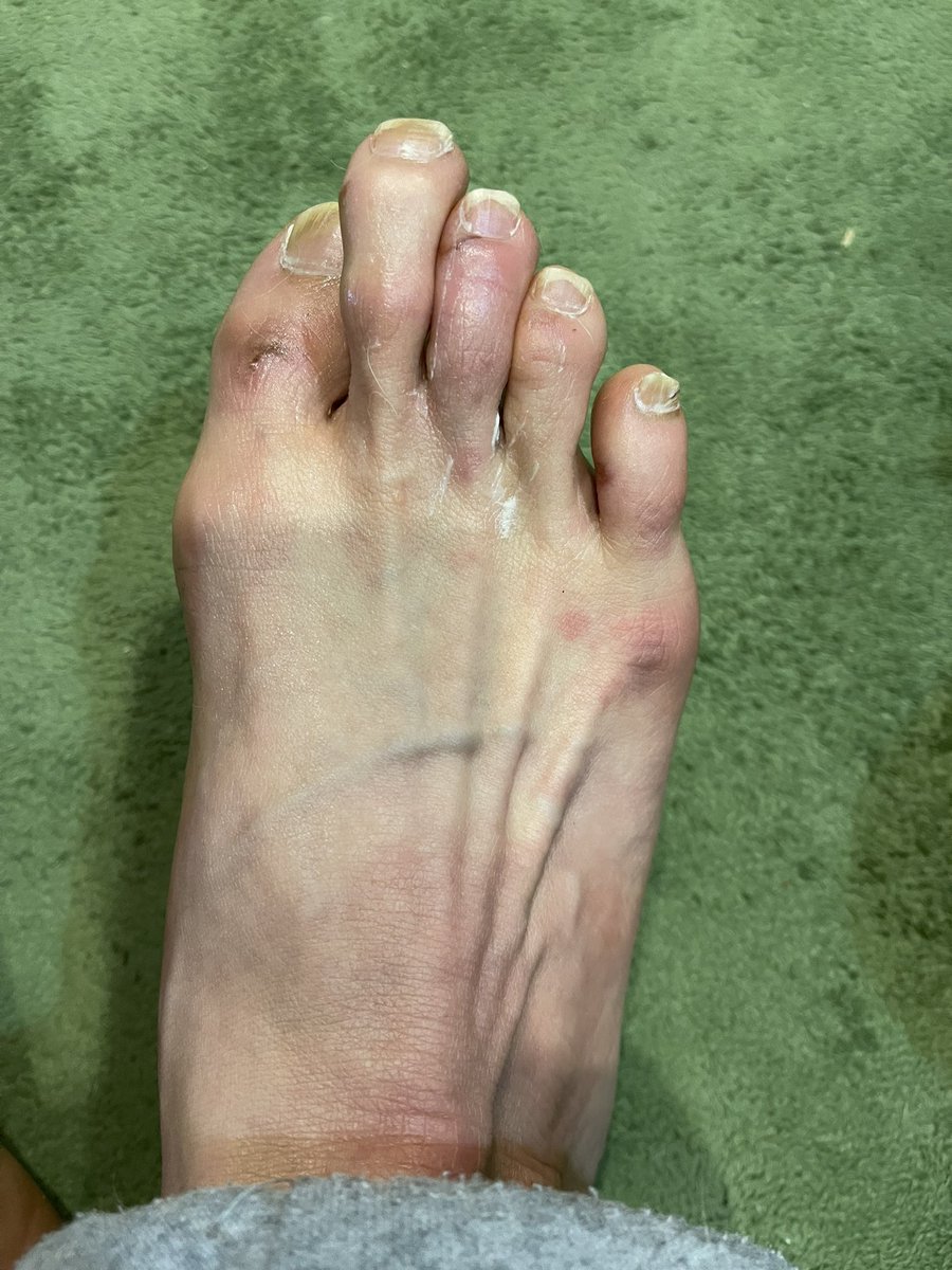 霜焼けでユベラ塗ったら足先だけ美肌になった😅
肌白くなるんな🤔
#美肌