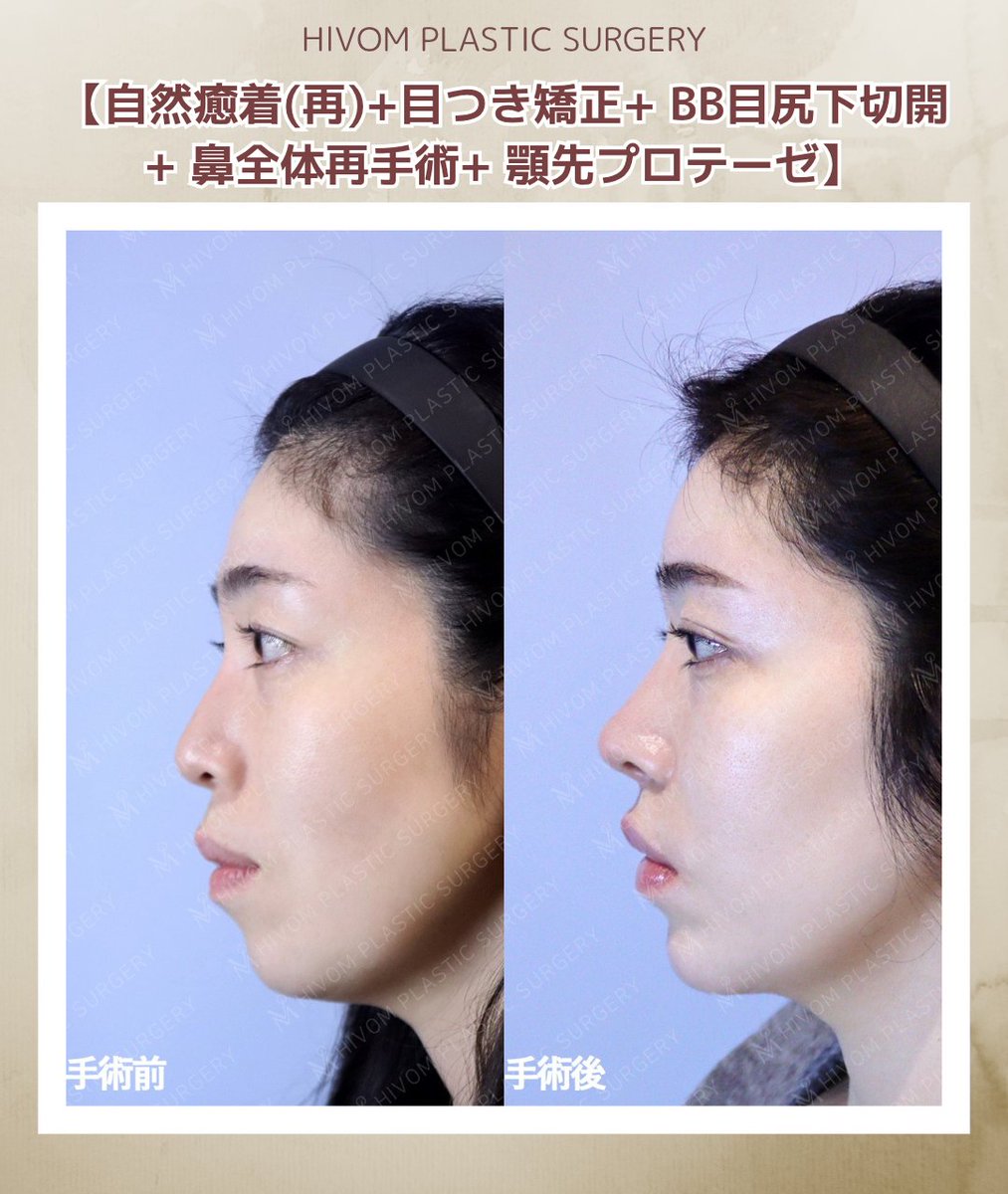 ハイボム美容外科🍑プチ整形🍑 tweet media