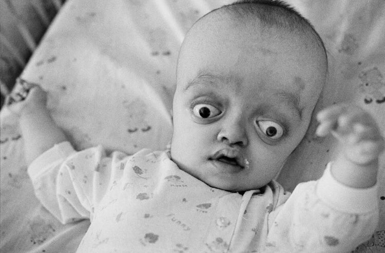 64 años después de empezar la guerra química en Vietnam, EEUU sigue impune y ni siquiera ha asumido su responsabilidad en hacerle esto a niños y a bebés vietnamitas, esto ni siquiera es noticia en Occidente.

Hasta tres generaciones de vietnamitas; hijos, nietos e incluso