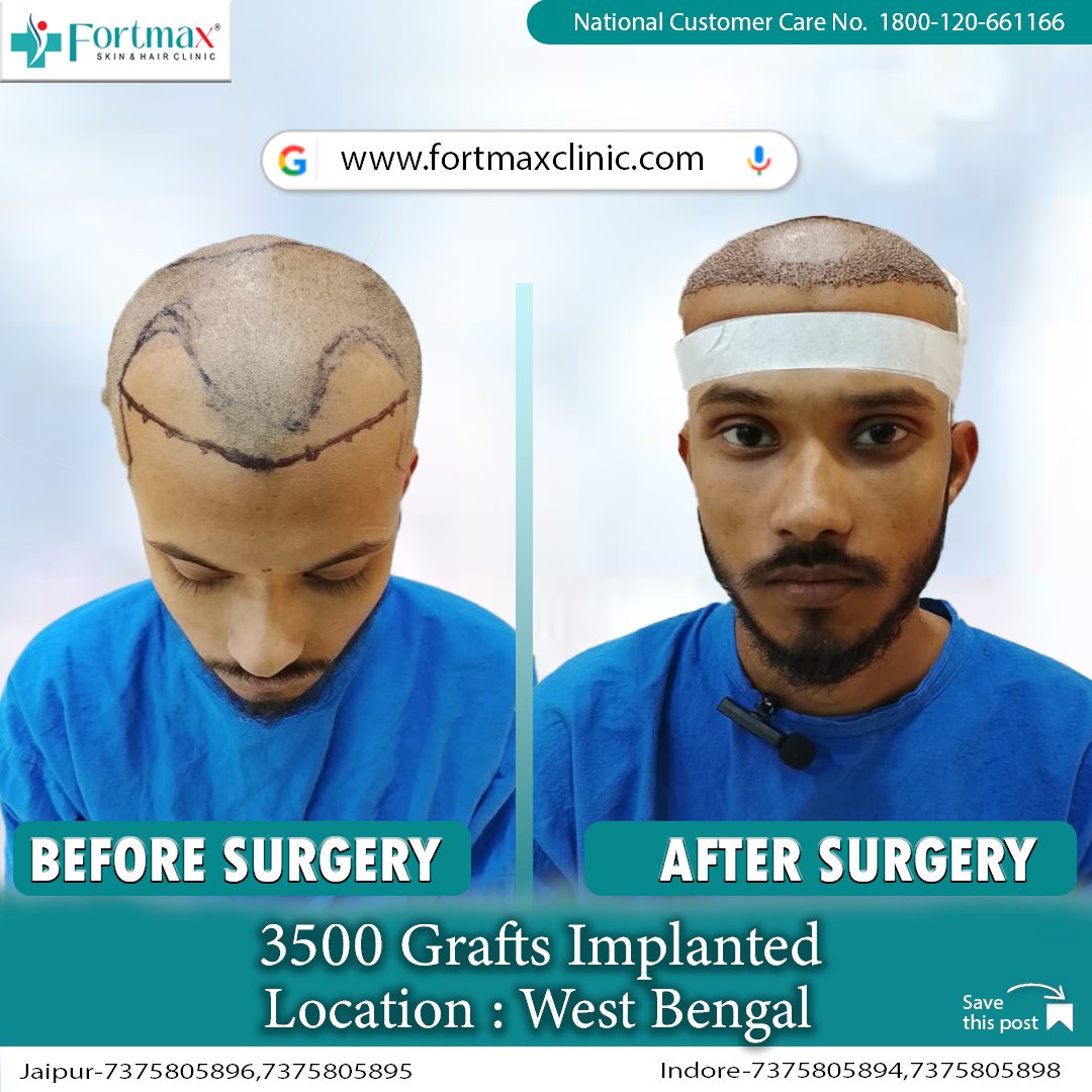 fortmaxclinic's tweet image. REAL RESULTS. REAL CHANGE. REAL YOU. ✨

Meet Rahees — who finally said goodbye to thinning hair and hello to a brand-new look. 🙌
💉 3500 Grafts Hair Transplant
Date = 05/01/2026
#hairtransplant #hairtransformation #hairrestoration #beforeafterhair #confidenceboost #naturalhair