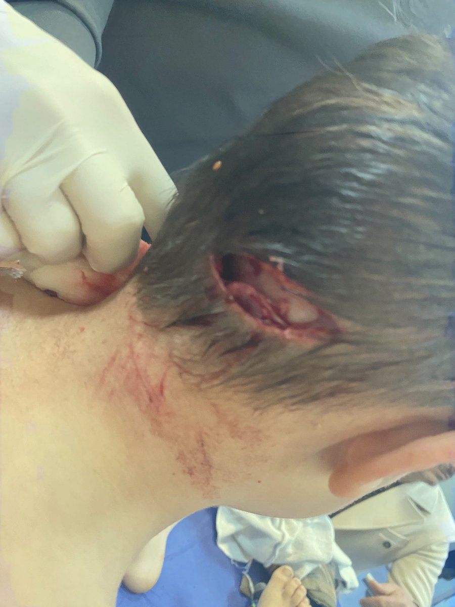 Muş’ta yaşayan 5 yaşındaki Talha #başıboş köpek tarafından kafasından ısırılmış, ambulans uçakla Ankara’ya getirilmişti. Köpek #kuduz çıkmış. 😢
#çocuklarımızsahipsizdeğil

Kaynak: <a href="/aslihan_ercan/">Av.Arb.ASLIHAN ERGÜN ERCAN ⚖️</a>