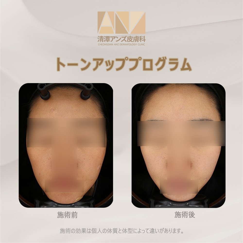 anzclinic's tweet photo. それぞれの肌に合わせた色素治療・ホワイトニング】

清潭アンズの色素治療ではそれぞれ違う肌の状態を診断し、肌タイプ、反応の程度に合わせて
毎回適したレーザーとエナジーを選択し1対1のオーダーメイドで治療が行われます！✨ https://t.co/JNiE5YHwNS