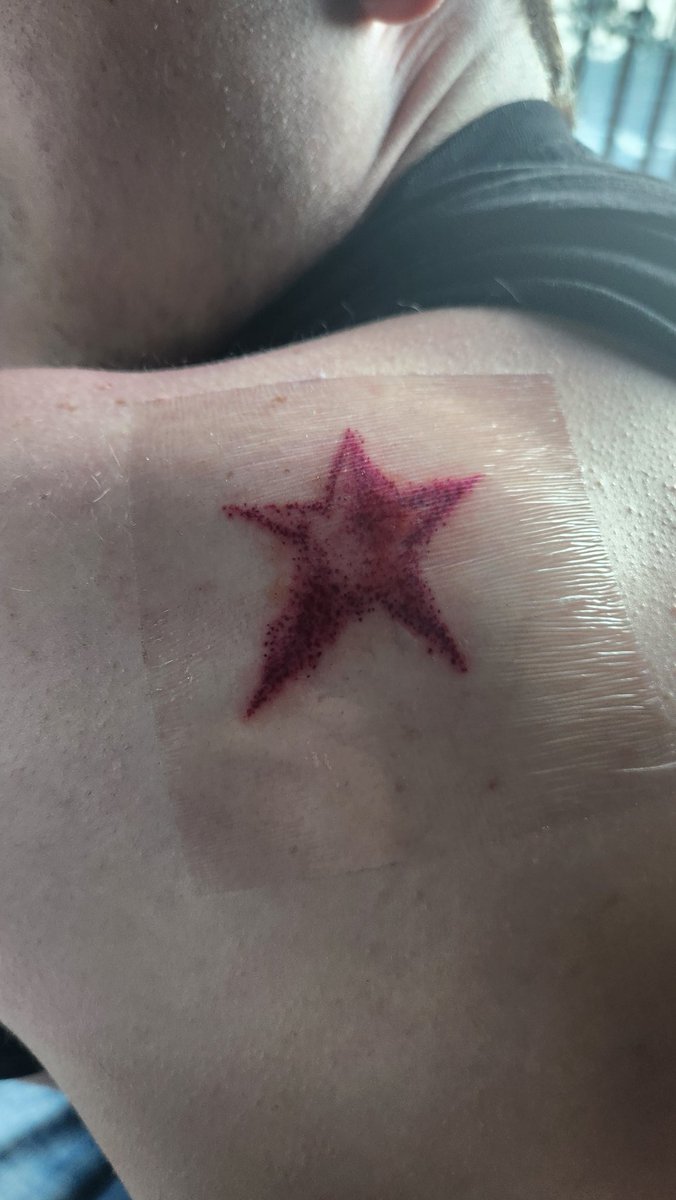 justenoughmilk's tweet photo. @avenbyevening I got the irregular more manga accurate one, this a pic from the day I got it ab a year or more ago. I like it bc as it fades it looks more like an actual birthmark since tjats what its supposed to be https://t.co/C8B6N7mVcI