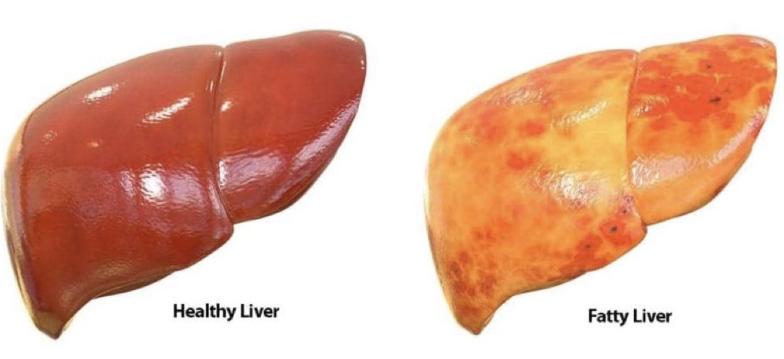 Karaciğer yağlanması neredeyse salgın halinde, insanların yaklaşık % 30’unda görülüyor. Her gün yaptığım ultrasonlarda da buna şahit oluyorum. Basit bir şey gibi görülse de ciddiye alınması gereken bir durum.