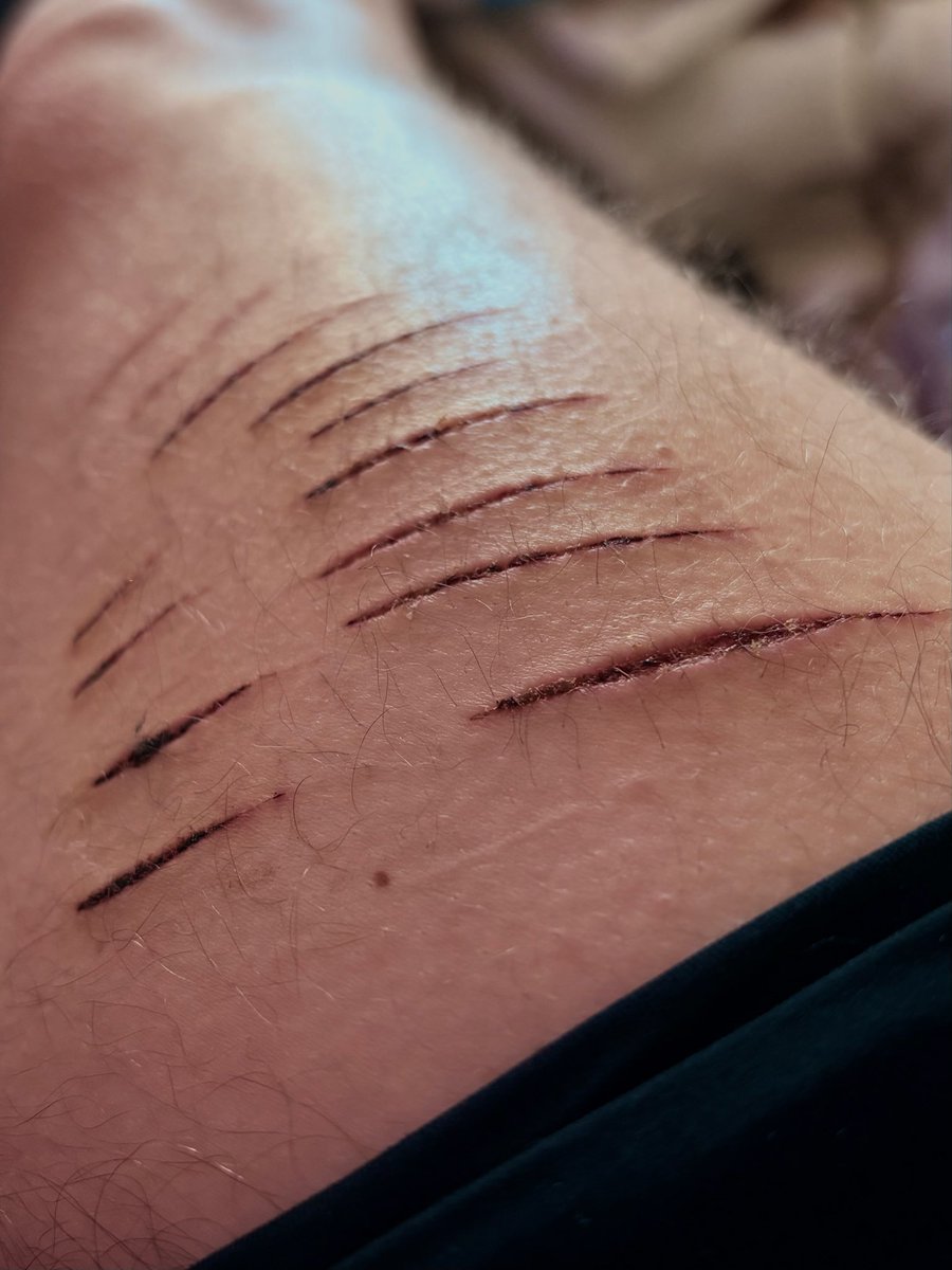 lowk does anyone else really love the way styros scab ... like why are they prettier than what the scars will end up being 💔💔💔 i have horrible scar luck