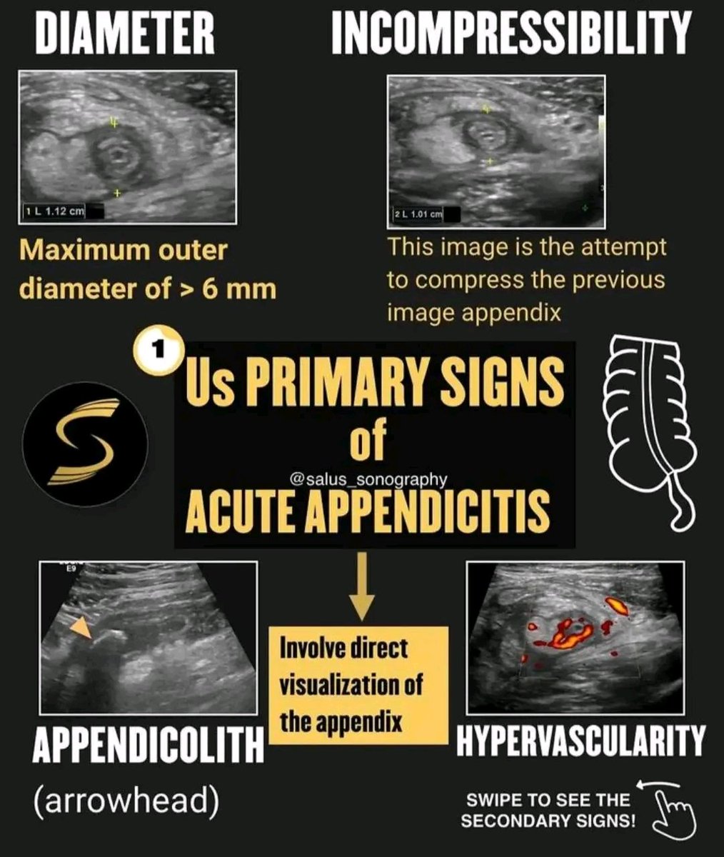 mznljrdy47597's tweet image. Appendix 

#ultrasoundscan #ultrasoundtech #ultrasound #UltrasoundTherapy #radiology