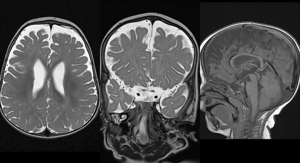 mehtanikhil's tweet photo. 🧠 Peds NeuroRad quick poll:
10‑month‑old with macrocephaly.
MRI attached.
Most likely?
1) BESS
2) Aqueductal stenosis
3) Subdural effusion/collection
4) Communicating hydrocephalus
Drop your “ONE best sign” 👇#PediNeuroRad #NeuroRad #PedsRad #FOAMRad #RadTwitter @The_ASPNR https://t.co/chkLySfey9