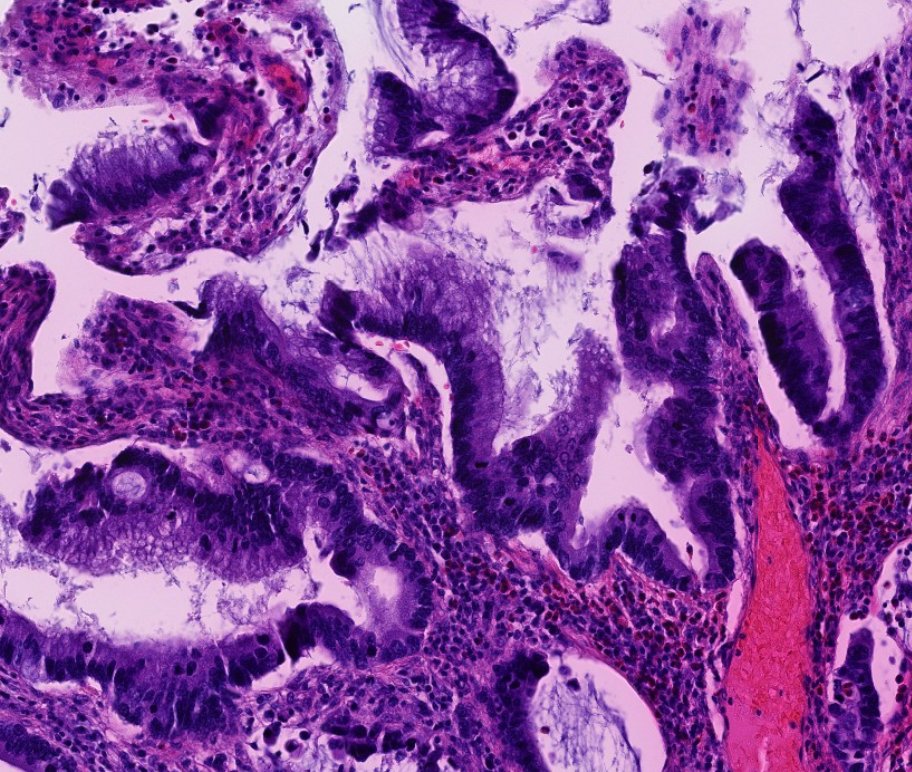 Janiranavarro's tweet photo. Patients with longstanding IBD (especially ulcerative colitis) are at risk for developing dysplasia and cancer.

Non-conventional dysplasia has been described in IBD:
- Hypermucinous (pic 1 and 2)
- Goblet cell deficient
- Dysplasia with increased Paneth cell differentiation
- Serrated dysplasia (including SSP/SSL-like, traditional serrated adenoma-like, and NOS)
- Dysplasia with terminal epithelial differentiation

P53 mutant pattern and loss of SATB2 expression can aid in the diagnosis of IBD-associated dysplasia.

The majority of non-conventional dysplasias were associated with ulcerative colitis and mucinous adenocarcinoma (pic 1).

Dr. Krasinskas - Tips and Hints in Surgical Pathology #USCAP #pathology #PathX