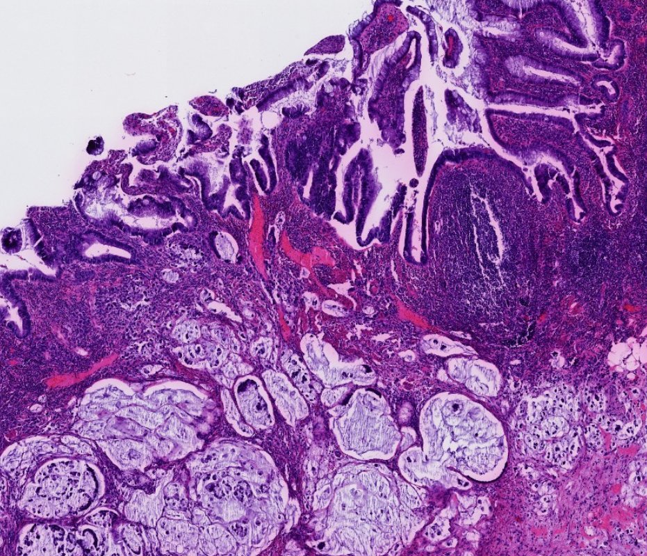 Janiranavarro's tweet photo. Patients with longstanding IBD (especially ulcerative colitis) are at risk for developing dysplasia and cancer.

Non-conventional dysplasia has been described in IBD:
- Hypermucinous (pic 1 and 2)
- Goblet cell deficient
- Dysplasia with increased Paneth cell differentiation
- Serrated dysplasia (including SSP/SSL-like, traditional serrated adenoma-like, and NOS)
- Dysplasia with terminal epithelial differentiation

P53 mutant pattern and loss of SATB2 expression can aid in the diagnosis of IBD-associated dysplasia.

The majority of non-conventional dysplasias were associated with ulcerative colitis and mucinous adenocarcinoma (pic 1).

Dr. Krasinskas - Tips and Hints in Surgical Pathology #USCAP #pathology #PathX