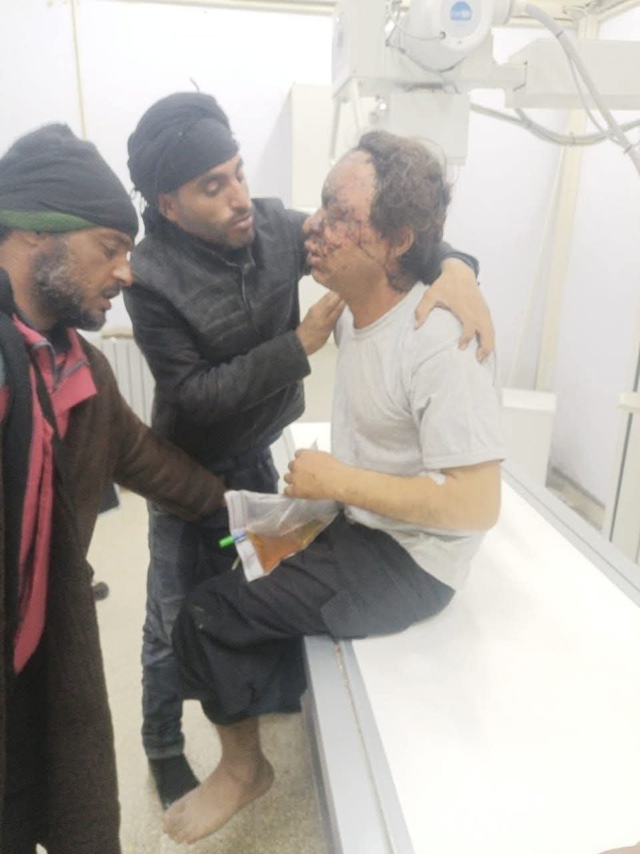 📌 دعوة لأهل الخير بالذات المتواجدين بالشام 

الشاب عز الدين (20) سنة من ابناء جبل عبدالعزيز، فقد بصره بسبب انفجار لغم ارضي به من ألغام ميليشيات (YPG/PKK). حين كان يجمع بعض الحشائش لطبخها. الشاب موجود بمشفى المواساة. وضع العائلة المادي تحت الصفر، يلي يقدر يساعد لا يقصر أهلنا. هذا