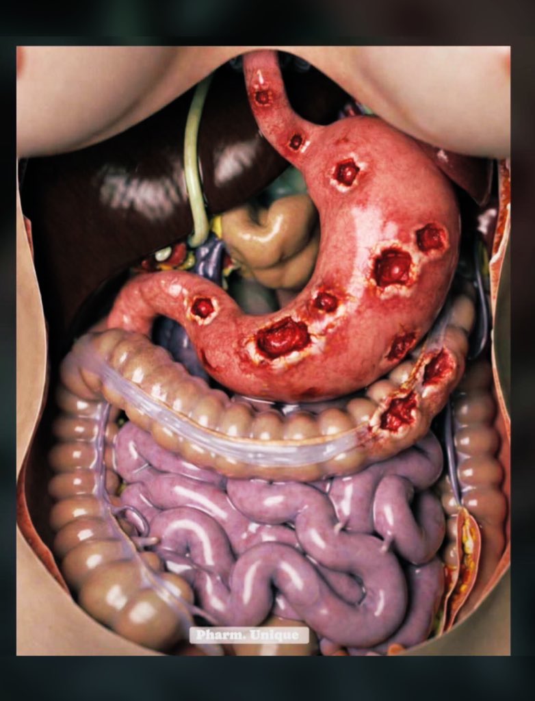 This is what an ulcer does to the stomach and the surrounding organs, so if you know someone suffering from an ulcer, convince them not to joke with their feeding as it can lead to rectal bleeding and una go talk sey na poison. I'm saying this now. Ulcers are so painful and