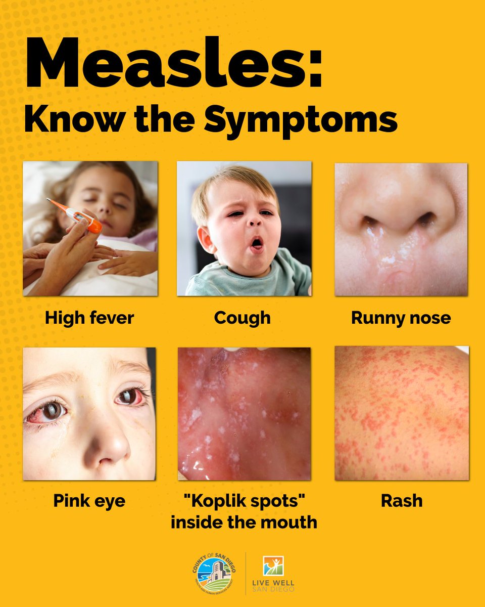 Measles is a serious and highly contagious disease. Know the symptoms ...