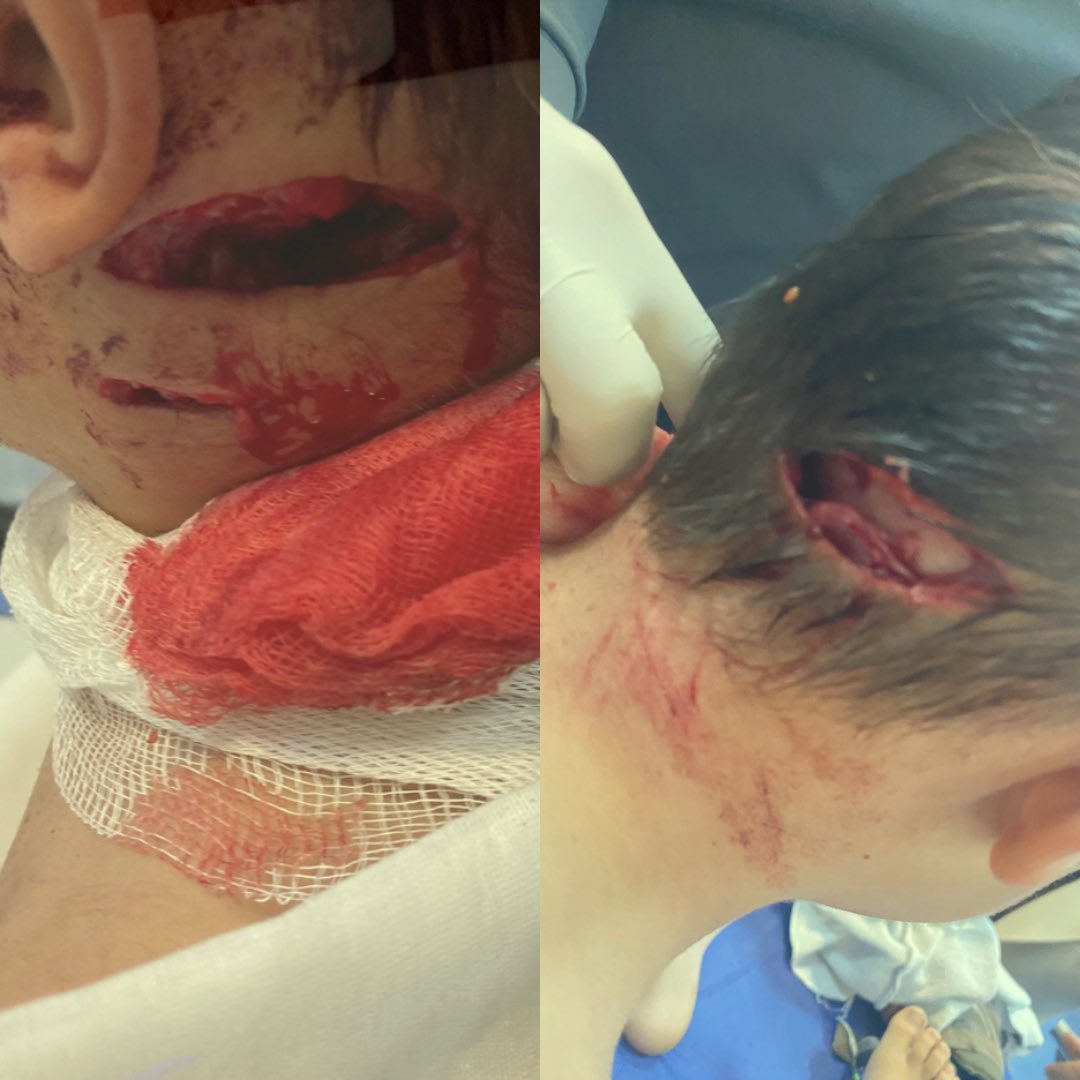 Muş’ta yaşayan 5 yaşındaki Talha #başıboş köpek tarafından kafasından ısırılmış, ambulans uçakla Ankara’ya getirilmişti. Köpek #kuduz çıkmış. 😢
#çocuklarımızsahipsizdeğil

Kaynak: <a href="/aslihan_ercan/">Av.Arb.ASLIHAN ERGÜN ERCAN ⚖️</a>