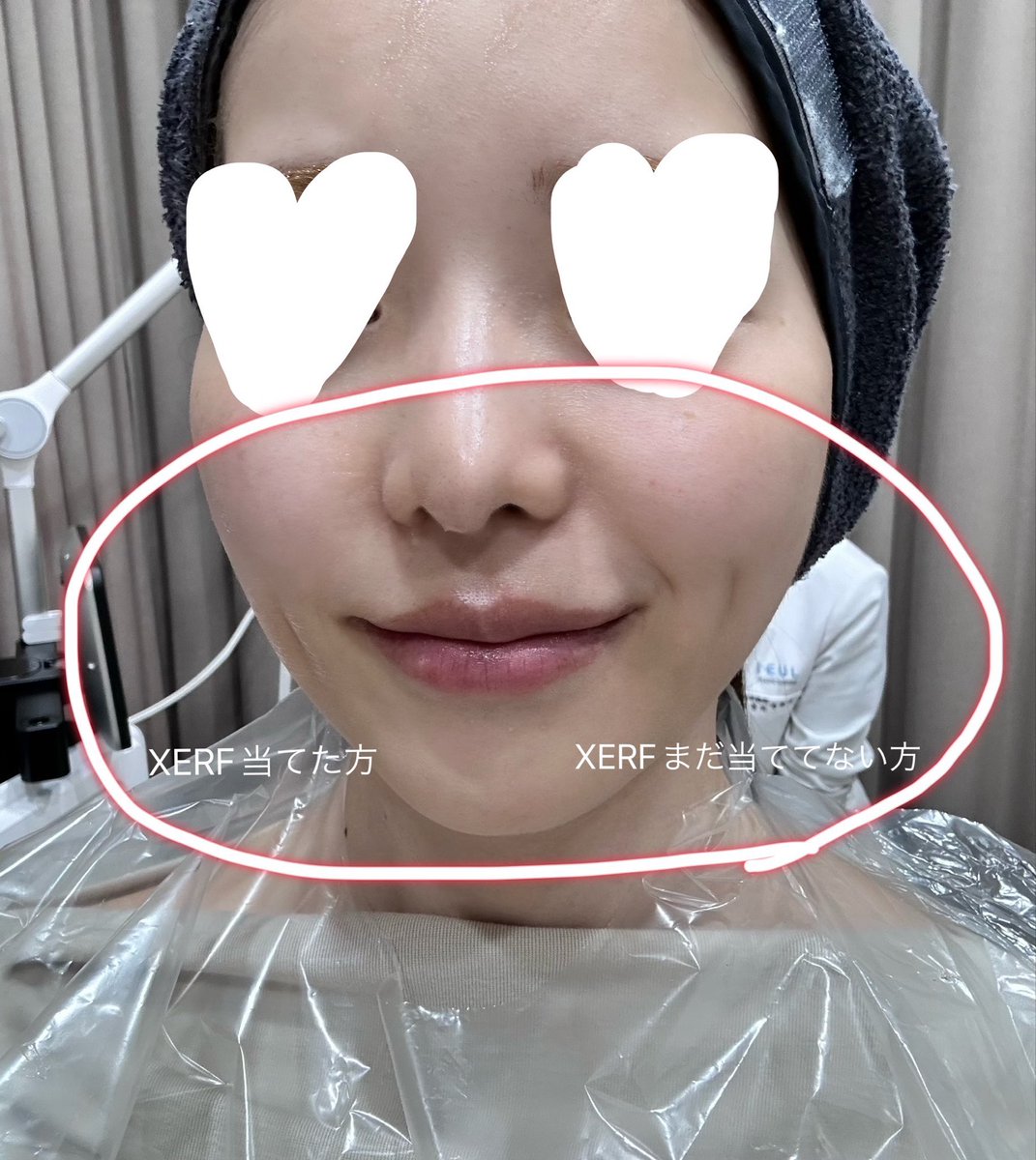 tako_____ta's tweet photo. 「ほうれい線が凄い」とｱﾝﾁｺﾒﾝﾄされたのでXERF受けてみたら衝撃を受けた話、 https://t.co/FUATDPdryc