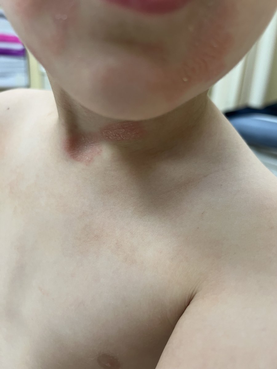 What is this lesions ? <a href="/IhabFathiSulima/">Dr Ihab Suliman</a> #MEDHTM <a href="/hemo_shk/">Dr.Haitham Hamoud | د.هيثم</a> @Jkbjb1 #TooCloseToDiagnose <a href="/MoarSahitoPTI/">Dr. Muhammad Moor</a>
<a href="/MRCEMPREP/">Daily Dose of Medicine</a>
<a href="/neoskinhealer/">Dr. ISHWAR N RATHORE MD</a>