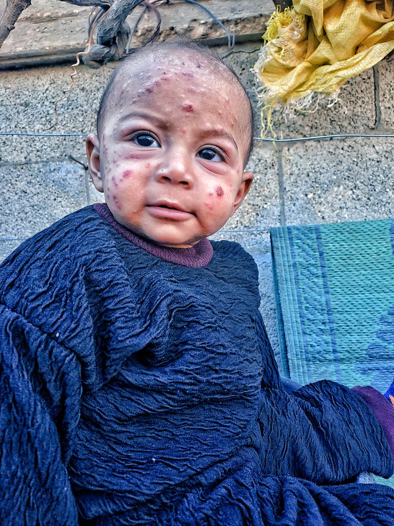 HEr Skin DiSeaSe has not improved, and the rashes continue to appear and spread across her small face. Her eyes are swollen and tired, and the pain is visible in them. She cries often because the burning and itching never stop, and she cannot find the comfort her small body