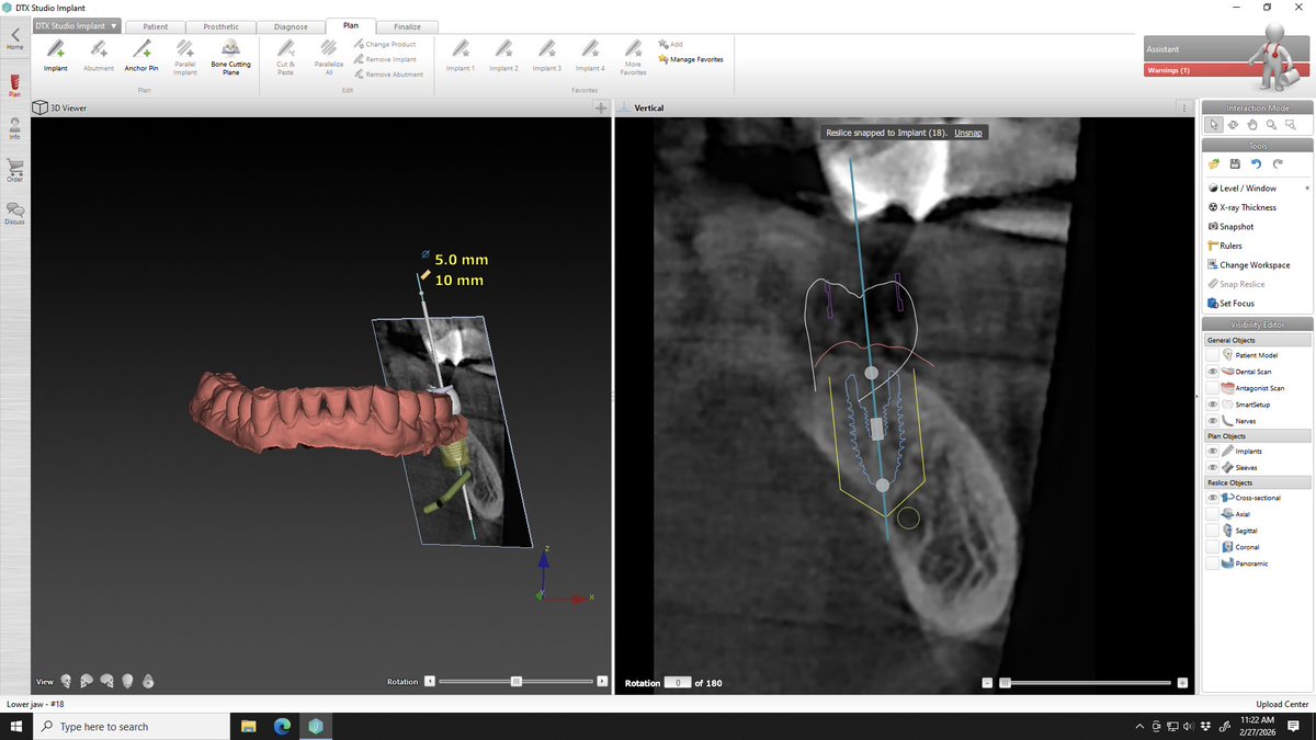 KennerDental's tweet photo. ✅ treatment planning complete. 

I don’t usually replace 2nd molars with implants due to anatomic limitations, and the gain in chewing function relative to the cost. But in this case, the patient wanted it and after doing the work up, is feasible. https://t.co/TqU5pOuTc3