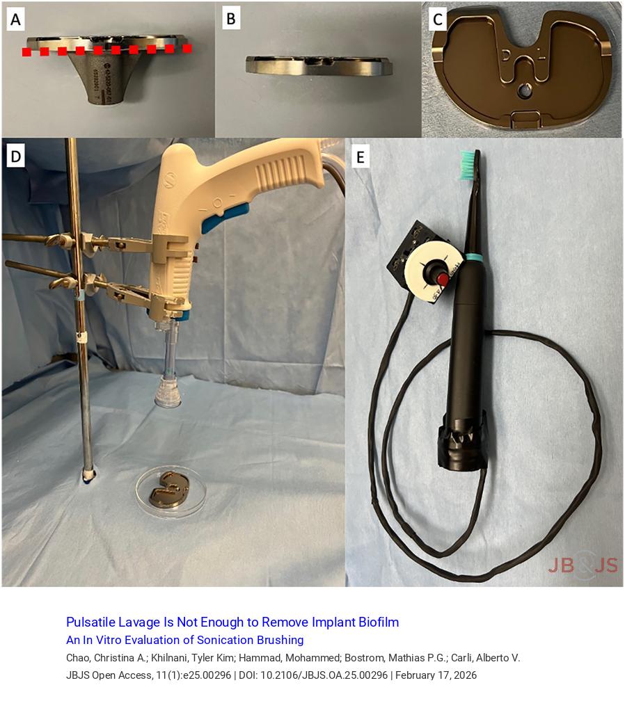 jbjs's tweet image. "Pulsatile Lavage Is Not Enough to Remove Implant Biofilm: An In Vitro Evaluation of Sonication Brushing" by Chao et al. 

Read the full article 👉 bit.ly/46faBPF

#infection #knee #hip #basicscience