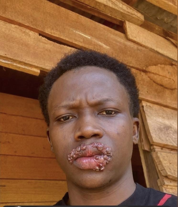 Twitter people I need help, I can't keep quiet anymore.

I slept and woke up and this stuff started growing all over my lips, I can't even eat properly anymore. 

Please what can I use to treat this? 😩🙏🙏🙏
