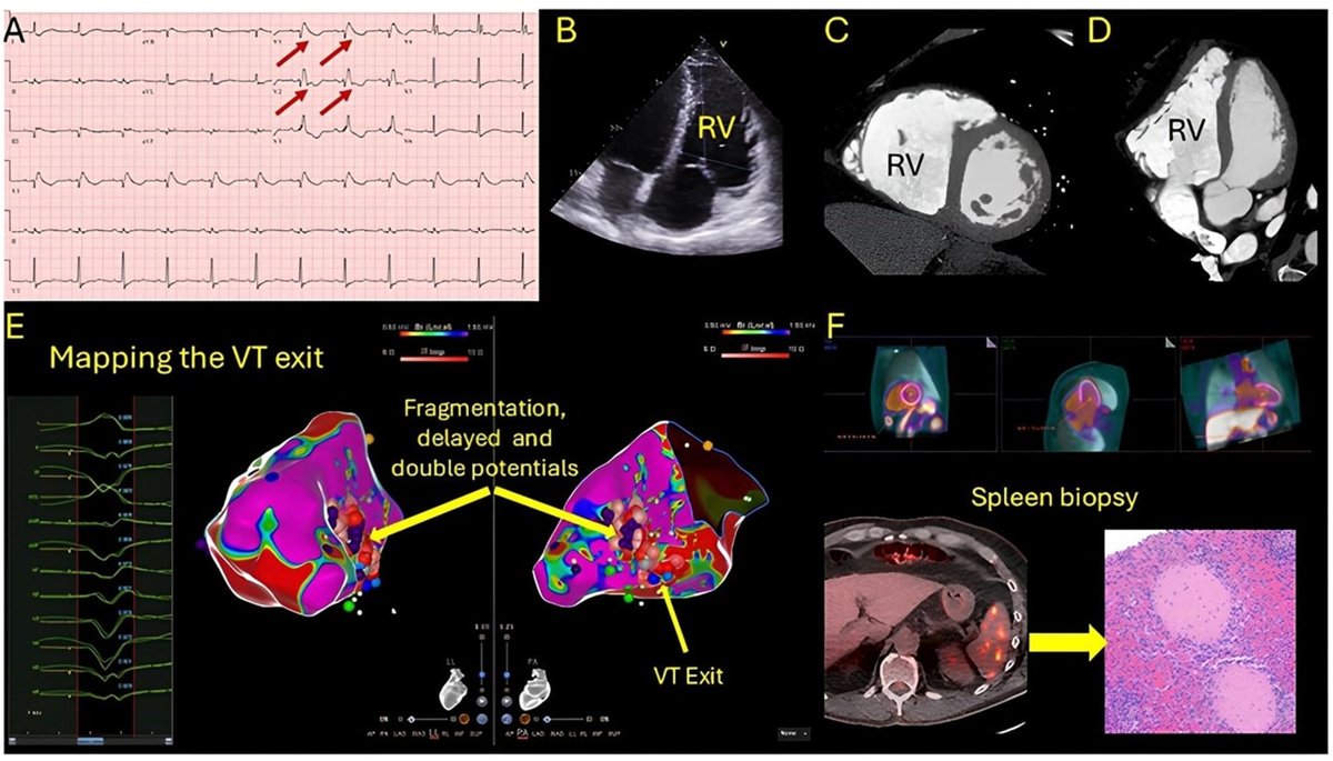 Heart Rhythm Case Reports tweet media
