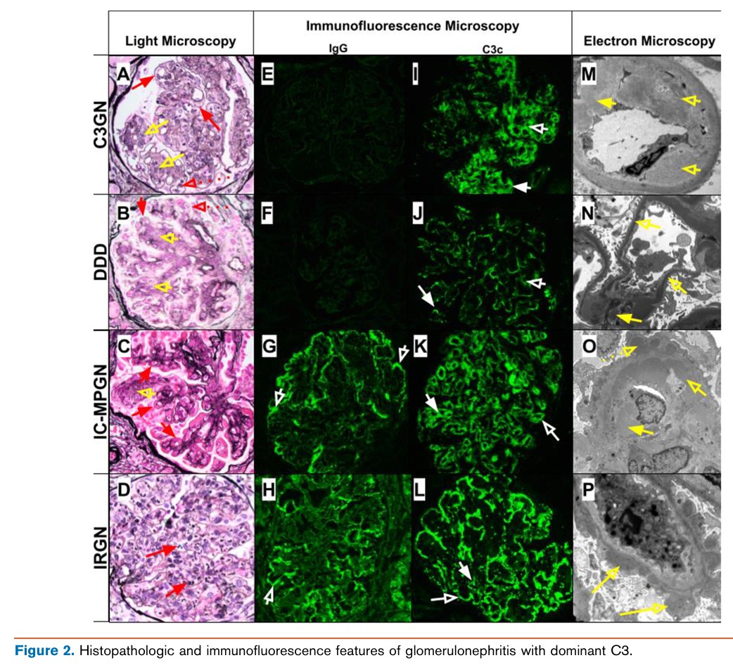 edgarvlermamd's tweet photo. C3 Glomerulopathy Diagnosis, Current Treatments, and Emerging Therapies ca. 2026 from @KidneyMed @JZRenalPath @IgAN_JBarratt @GlassockJ @DrRaymondHsu @Nephronpower @rahaai @SaynaNorouzi 
#Nephpearls 

👉 https://t.co/kJE6y57ag4 https://t.co/ixs4hmVtW4