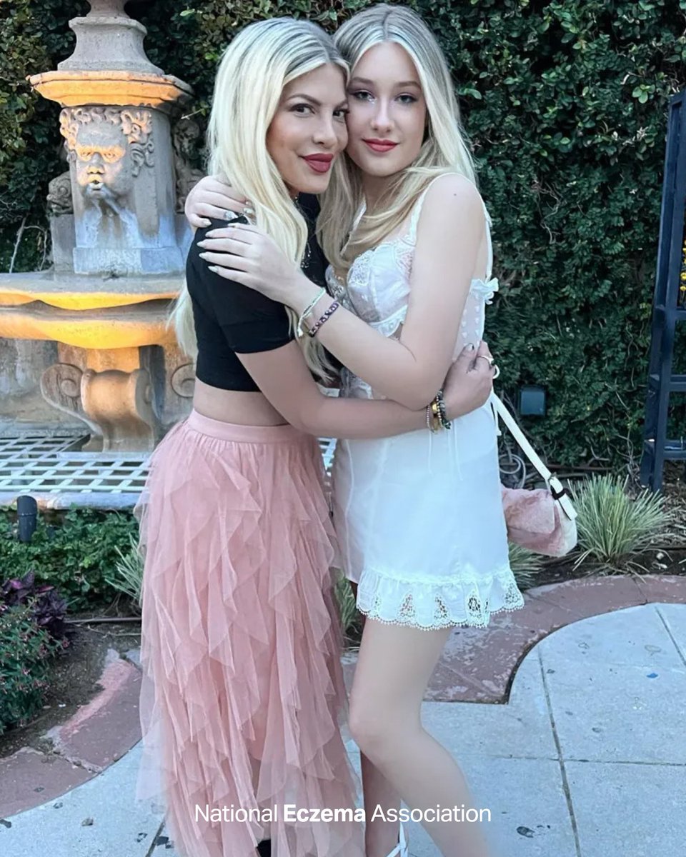 nationaleczema's tweet image. Special thanks to @ArcutisBio.

For Stella McDermott and her mother, @torispelling, their journey with #eczema has been marked by frustration, transformation and, ultimately, hope. Read why they’re using their platform to #UnhideEczema: nationaleczema.org/blog/spelling-… 

#FreeToBeMe