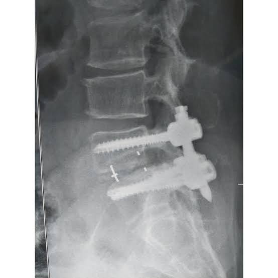 mastery_em's tweet photo. Despite prevoius back surgery for pain; such as discectomy or laminectomy, some patients continued to have back pain. They also drop frequently in ED for analgesics‼️
What is this syndrome called? https://t.co/UCq3WLVz6p