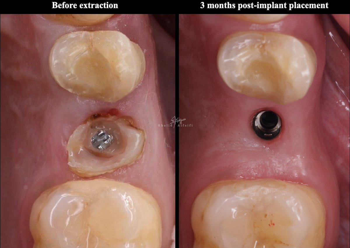 dralfaifii's tweet photo. Although it is hard, it is not impossible 

- Gingival Tissue Recontouring Using a PMMA Provisional Crown: A Step-by-Step  ✨

- supervised by @Saleh_alhindi https://t.co/cnrrNymwjf