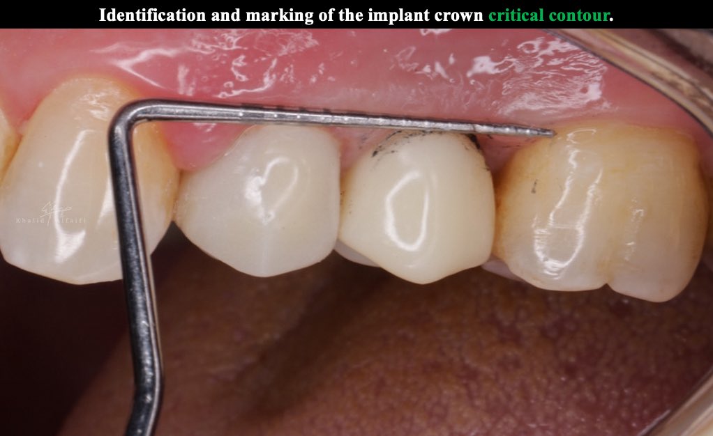 dralfaifii's tweet photo. Although it is hard, it is not impossible 

- Gingival Tissue Recontouring Using a PMMA Provisional Crown: A Step-by-Step  ✨

- supervised by @Saleh_alhindi https://t.co/cnrrNymwjf
