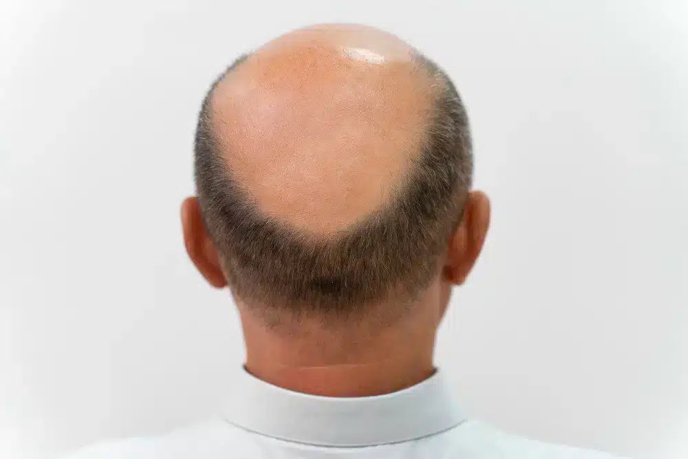 🇯🇵 | ¡Bombazo científico desde Japón! 🇯🇵
Investigadores de Riken y OrganTech han descubierto una "tercera célula" clave para regenerar el cabello por completo. Al sumarla al folículo, el pelo no solo crece, sino que cumple su ciclo natural de forma infinita.