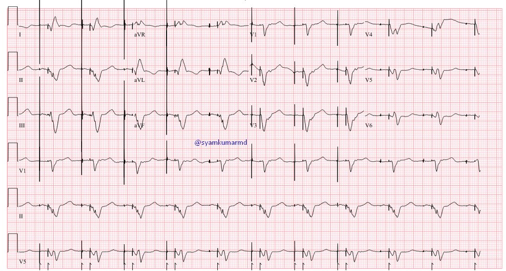 syamkumarmd's tweet image. Case of NICM with severe LVD, post-CRT. LV lead failure and high thresholds. Bailout CSP done. What do you see here?#Epeeps