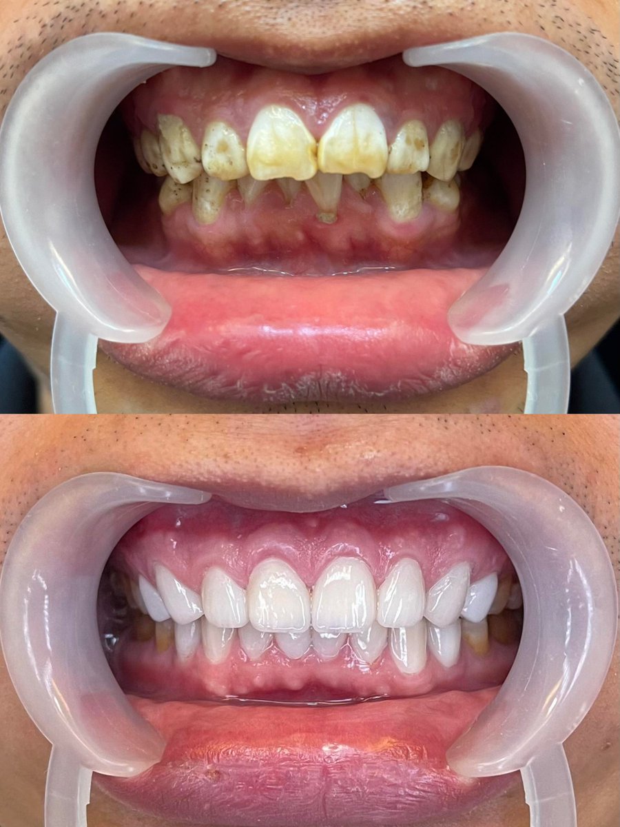 DrLeoSurgery's tweet photo. Tooth veneer case comparison 🆚 Within our capabilities, everyone has the right to pursue beauty. Beauty has nothing to do with gender，This is a veneer technology for tooth whitening.The cost of this technology is relatively low.The effect is obvious, the duration will be good, and it will not affect.Your occlusal ability and sense of taste#牙齿贴面 #牙齿美白#氧化锆全瓷牙