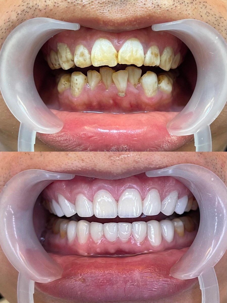 DrLeoSurgery's tweet photo. Tooth veneer case comparison 🆚 Within our capabilities, everyone has the right to pursue beauty. Beauty has nothing to do with gender，This is a veneer technology for tooth whitening.The cost of this technology is relatively low.The effect is obvious, the duration will be good, and it will not affect.Your occlusal ability and sense of taste#牙齿贴面 #牙齿美白#氧化锆全瓷牙