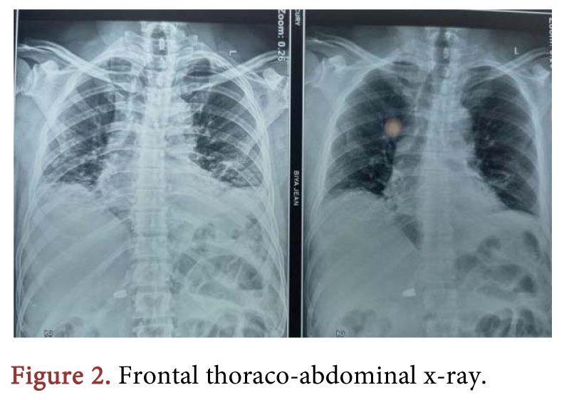 An Abdominal Gunshot Wound and a Bullet with an Intramuscular Trajectory: A Case Report
More @ tinyurl.com/jznse4c4 

Article by Gilbert Frank Olivier Ngongang, et al., from University of Yaoundé I (FMSB/UYI) (Cameroon), etc.