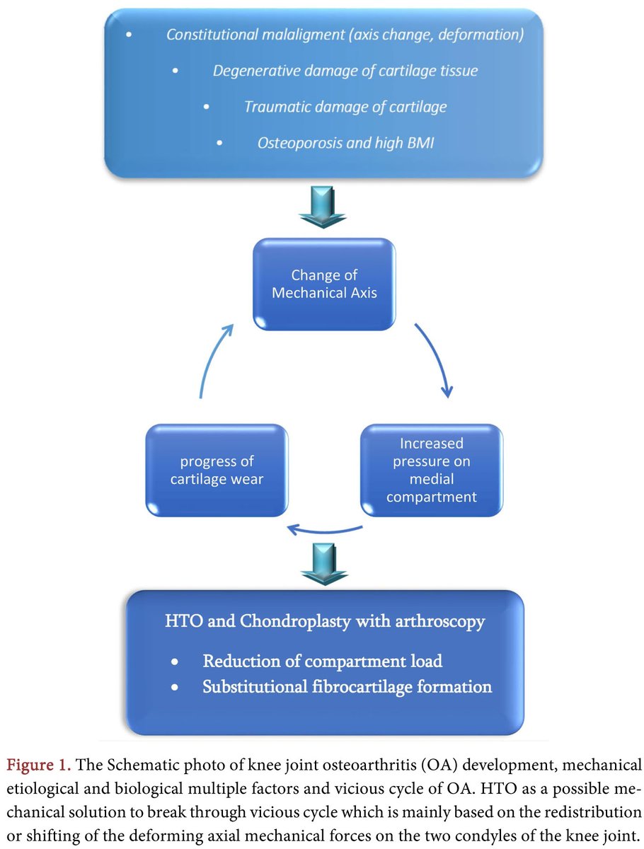 Knee Joint Medial Compartment Osteoarthritis Treatment with High Tibial Opening Wedge Osteotomy and Arthroscopic Chondroplasty
More @ tinyurl.com/3s4pnhrd 

Article by Irakli Khabeishvili, et al., from Tbilisi State Medical University, Georgia.