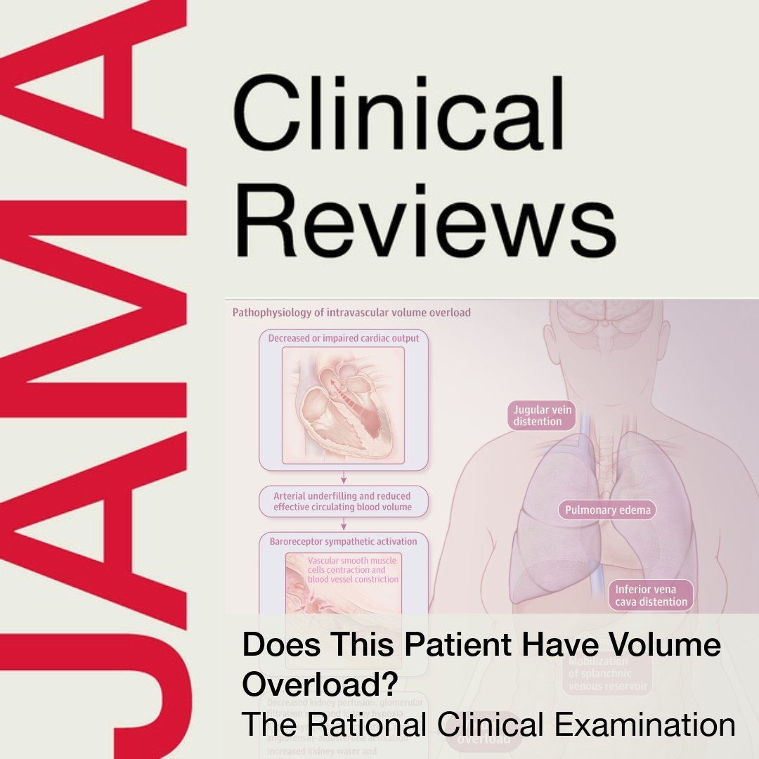 JAMA_current's tweet photo. In under 20 minutes, JAMA summarizes the latest evidence for diagnosing volume overload: clinical signs, BNP, and the emerging role of bedside ultrasound (POCUS). 

🔗 Learn pearls for practice, including B lines and IVC collapsibility in this podcast: https://t.co/1Sq9t5uxQN https://t.co/M1WlaCiti7