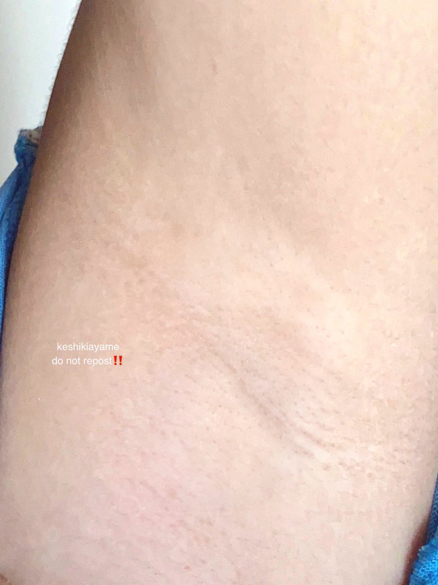 SATISFYING BANGET… ritual bersihin daerah lipatan.. selain bikin kulit ketiak lebih halus dan cerah tapi juga biar gak bau

Meskipun ketiak ga terekspos ternyata pas habis eksfoliasi langsung keangkat semua daki-dakinya 👍🏻