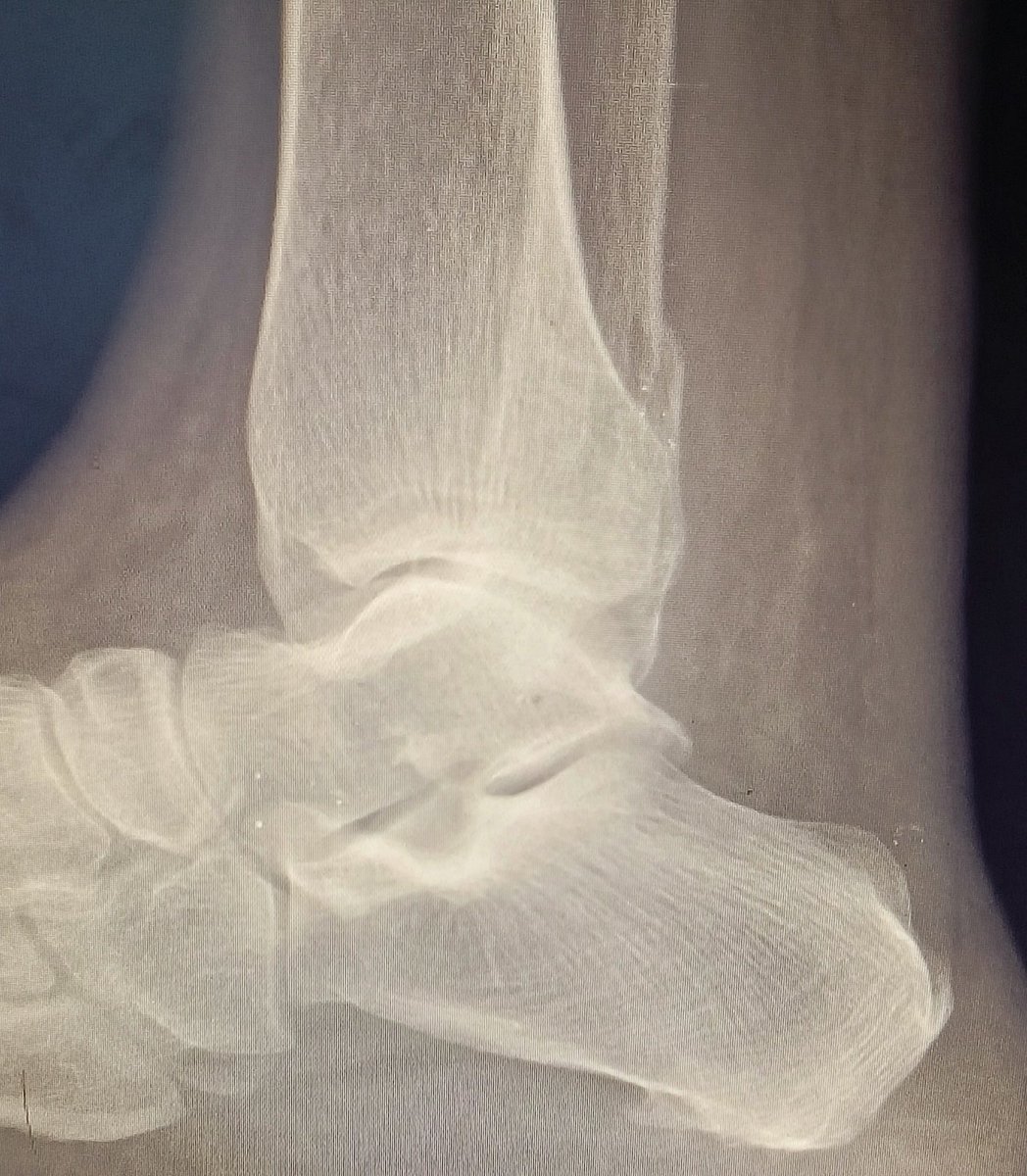 Kindly observe this x-ray. 

Any fracture line seen?