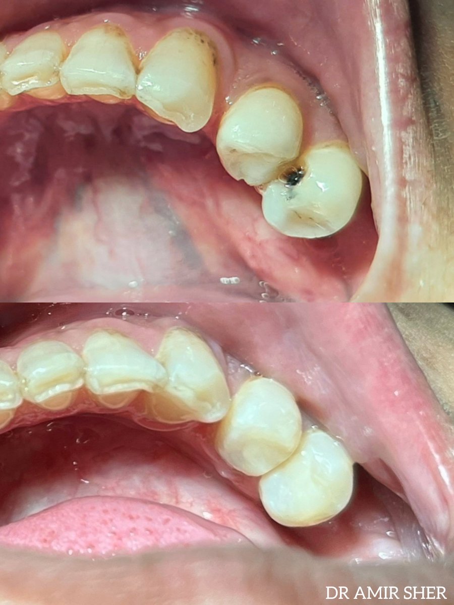 Primedental7's tweet image. Direct Composite Restoration of 1st &amp;amp; 2nd Premolars 🦷✔️

#DirectComposite
#OperativeDentistry
#CompositeRestoration
#RestorativeDentistry
#ToothConservation