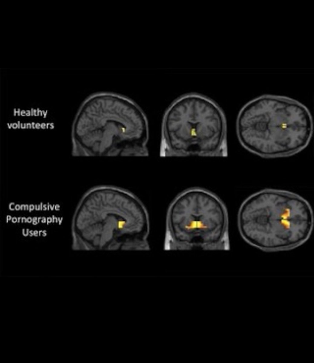 I found p*rnhub at 14
and watched it every night for 10 years
I’m 1098 days clean now. 

For all the men btw, here are the worst effects of watching p*rn backed by science. A thread.