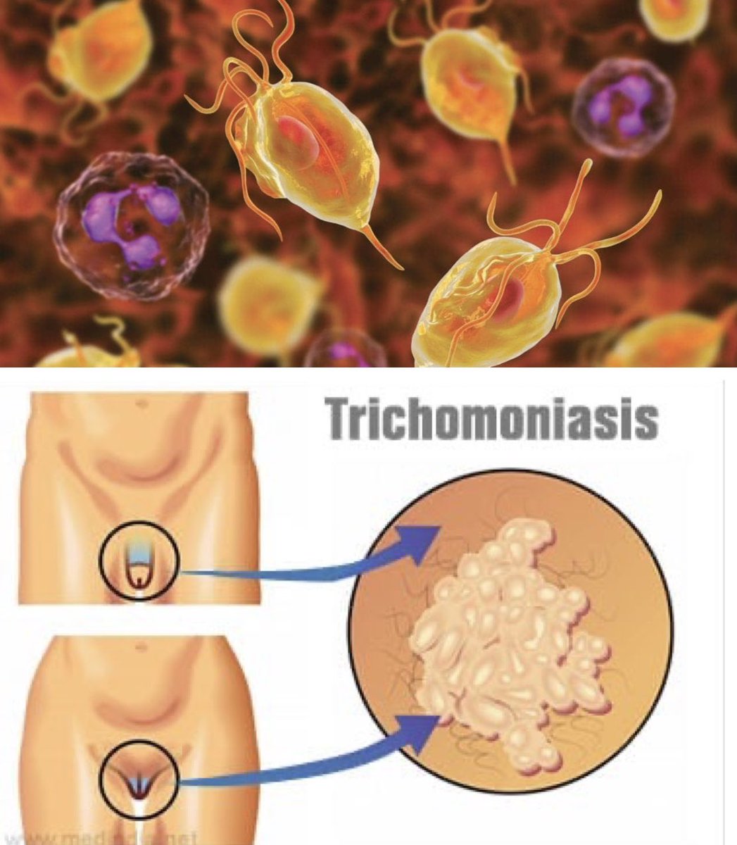 Today I will tell you about the symptoms of Trichomoniasis and steps to Fix it.

If you’re tapping out too soon, you’re MISSING out on the best part. 

Learn how to bounce back fast and do comment…

Thread -