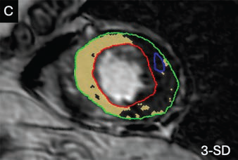AJR_Radiology's tweet photo. This multicenter study reveals that LGE is present in 15.7% of patients with Takotsubo syndrome and is associated with earlier MRI timing and greater edema, providing vital prognostic context for cardiac imaging. https://t.co/m921M5RbY9 https://t.co/DDeezeuayR