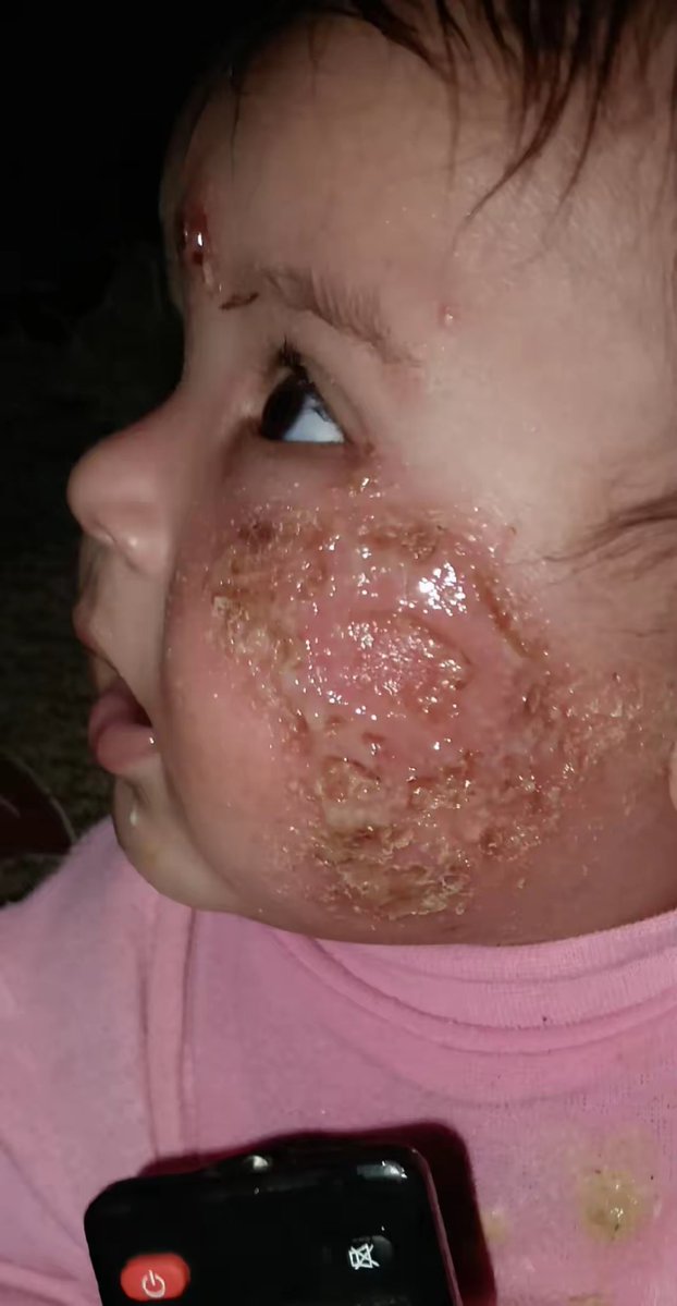 My child is suffering severely from a dangerous skin rash and a painful bacterial blood infection, and his condition is getting worse day after day…
Now the infection has started spreading to my daughter as well… and I stand helpless before this nightmare that is chasing my