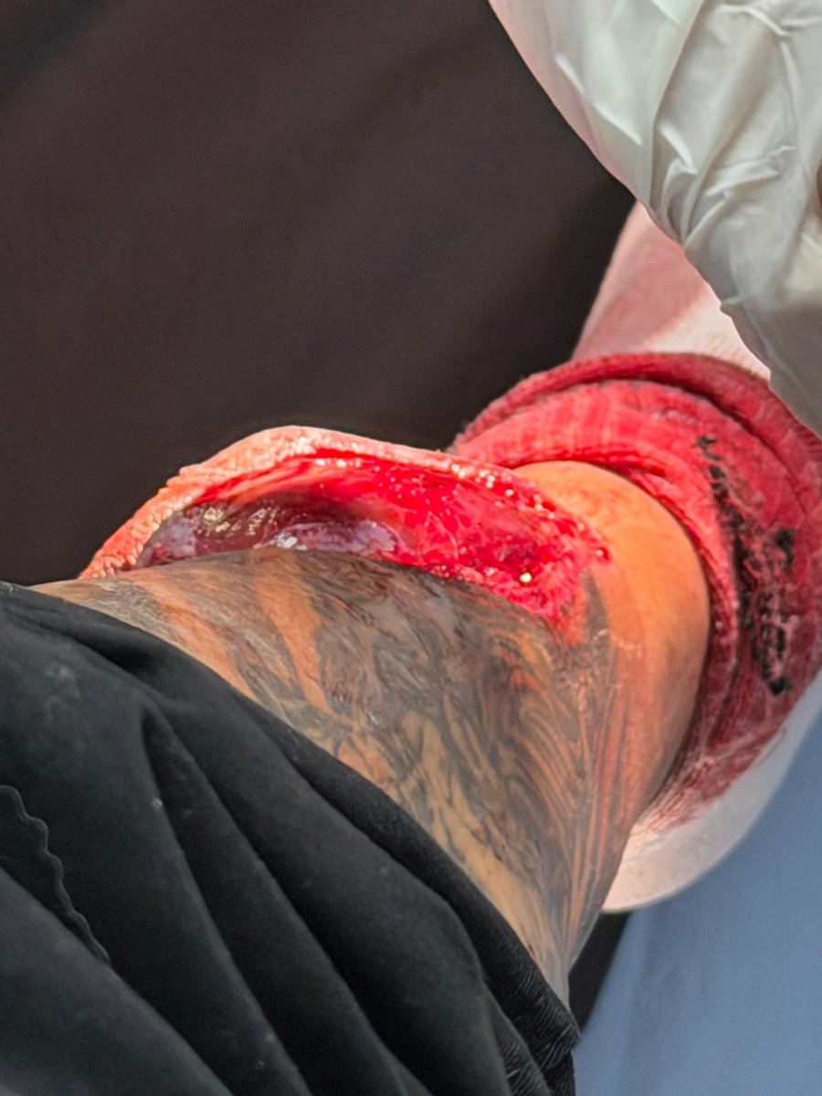 DonEmputado's tweet photo. Si les cuento todo lo que paso ayer en la zacamil con mi hermano , probablemente terminaria en demanda , resumen corto lo dejaro  24 hrs sin atencion , de una fractura expuesta, cuando lo vinierona atender ya tenia inicios de una infeccion.
(+) https://t.co/AU9o7mI1Pw