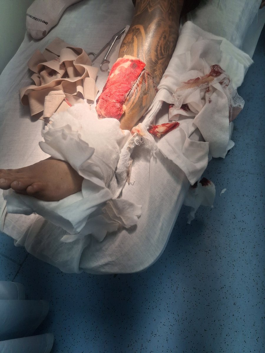 Si les cuento todo lo que paso ayer en la zacamil con mi hermano , probablemente terminaria en demanda , resumen corto lo dejaro  24 hrs sin atencion , de una fractura expuesta, cuando lo vinierona atender ya tenia inicios de una infeccion.
(+)