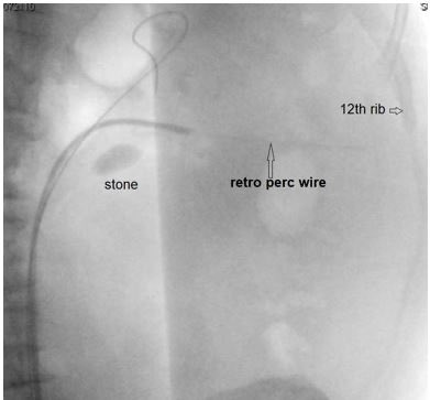 roger_sur's tweet photo. @RetroPerc data  (unpub) @bristolwhiles @DrUroTerry @drdavidh77  @DukeUrology Medairos, Tejwani researchers: puncture access feasible 95% (38/40), req single 
needle passage attempt (median 1, IQR 1–2). midcalyx
(69.2%), upper-pole (17.9%), and lower-pole (12.8%). https://t.co/dNXA4UTE5P