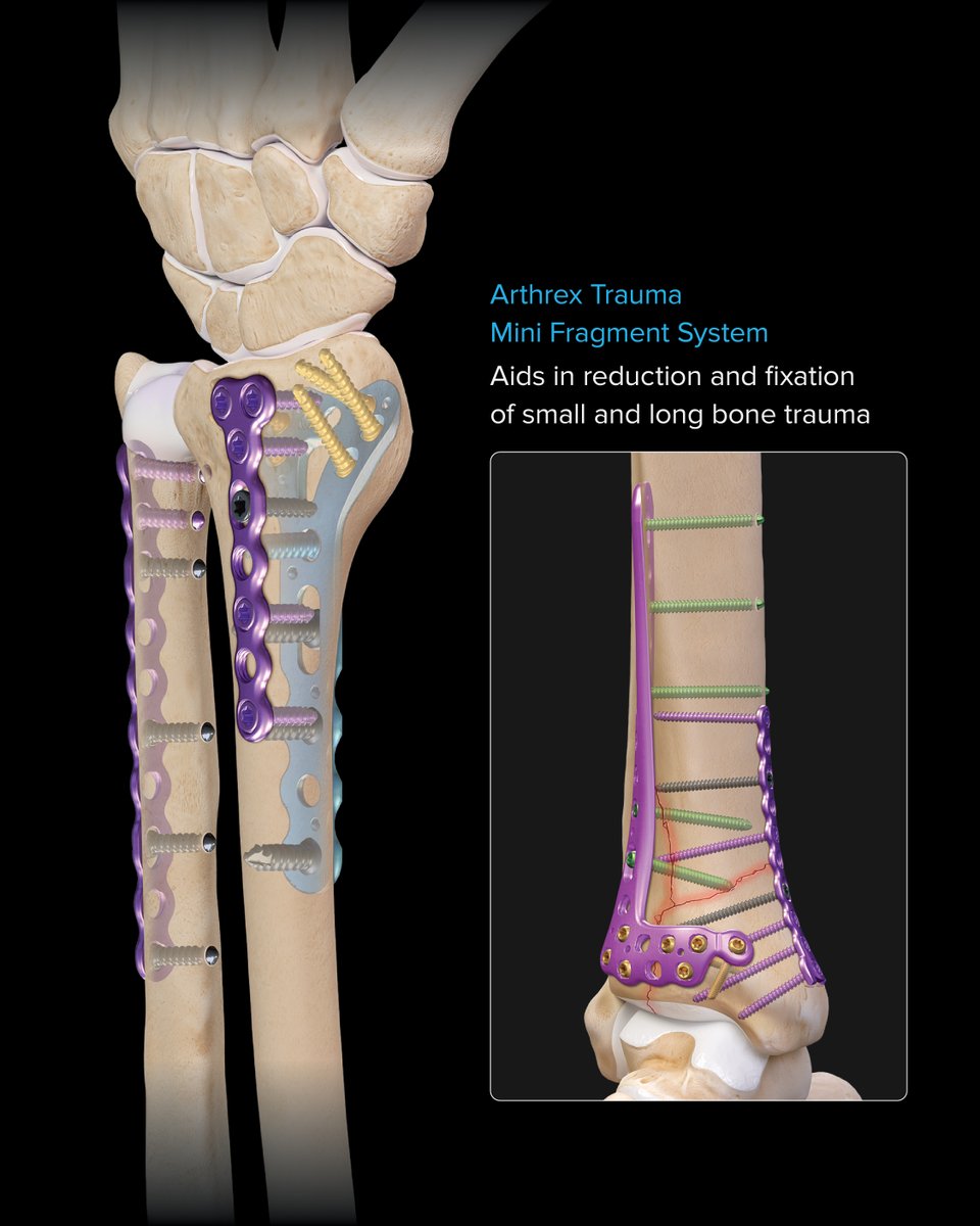 ArthrexMedEd's tweet photo. When you treat fractures, think Arthrex. Visit us at Exhibit 2239 Hall D during the #AAOS2026 Annual Meeting in New Orleans, LA to learn about our latest trauma innovations.

Swipe to view key fracture management products.

Learn more: https://t.co/U8GEV49skC

#AAOS #AAOS2026 #Arthrex #ArthrexTrauma